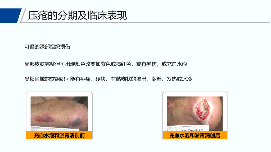 105#压疮预防和护理
