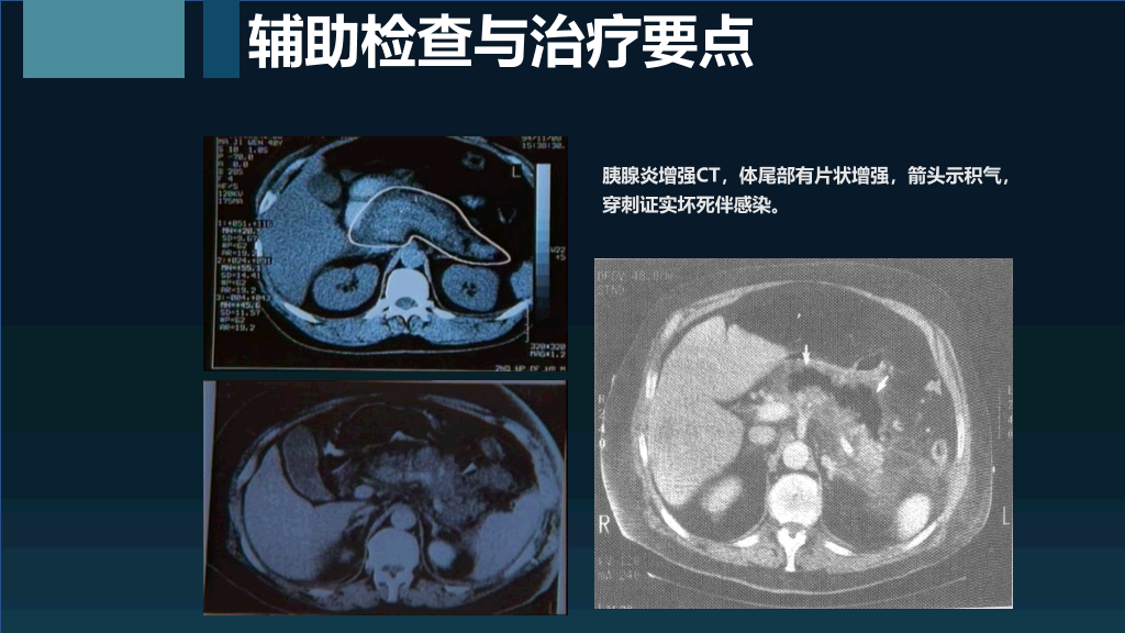 105#急性胰腺炎护理查房-2