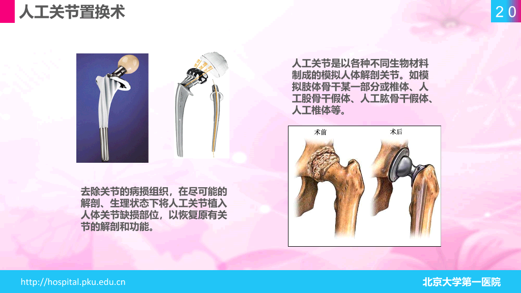 105#股骨颈骨折护理查房-1