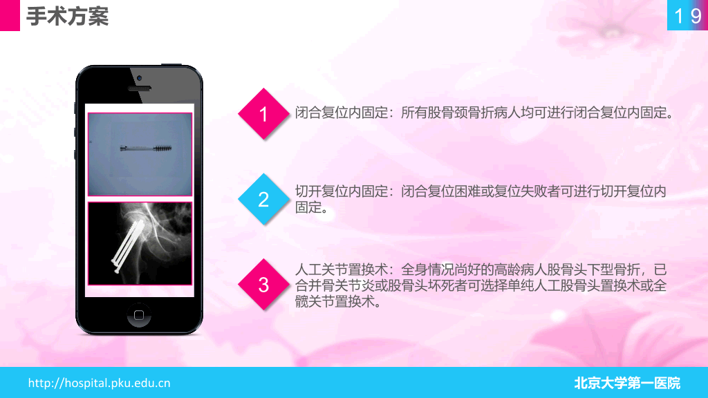 105#股骨颈骨折护理查房-1