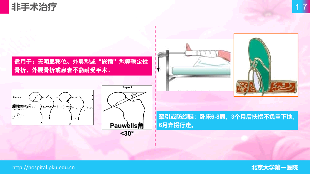 105#股骨颈骨折护理查房-1
