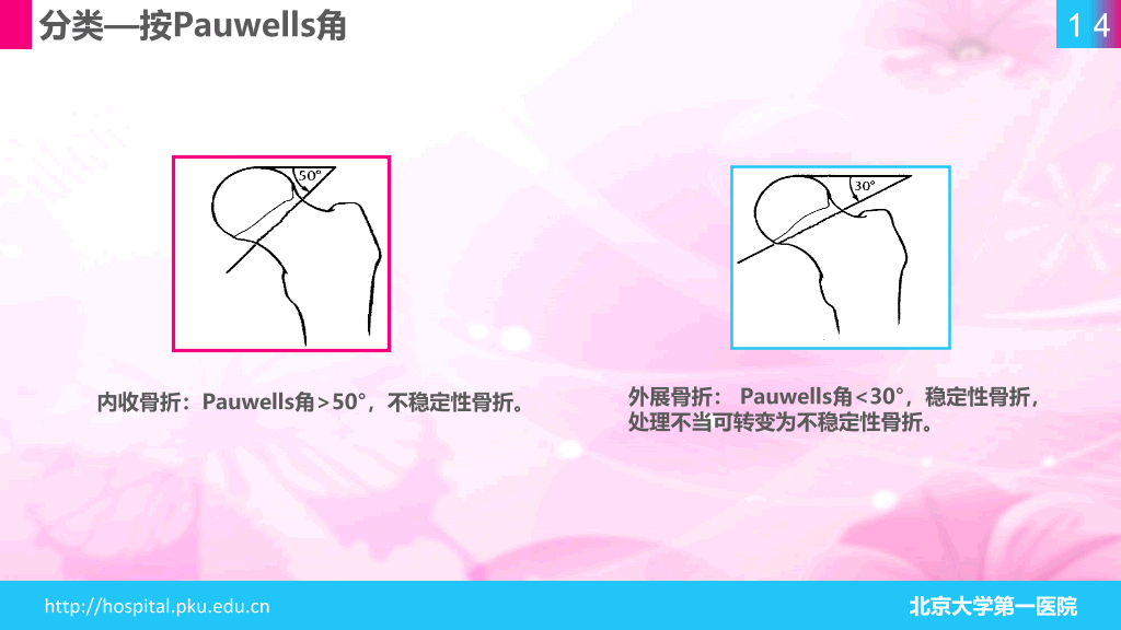 105#股骨颈骨折护理查房-1