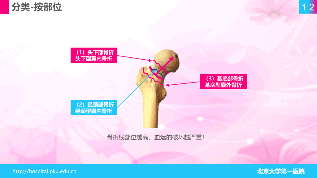 105#股骨颈骨折护理查房-1