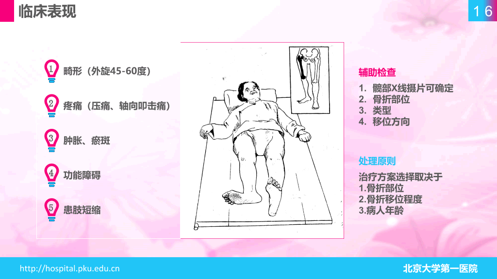 105#股骨颈骨折护理查房-1