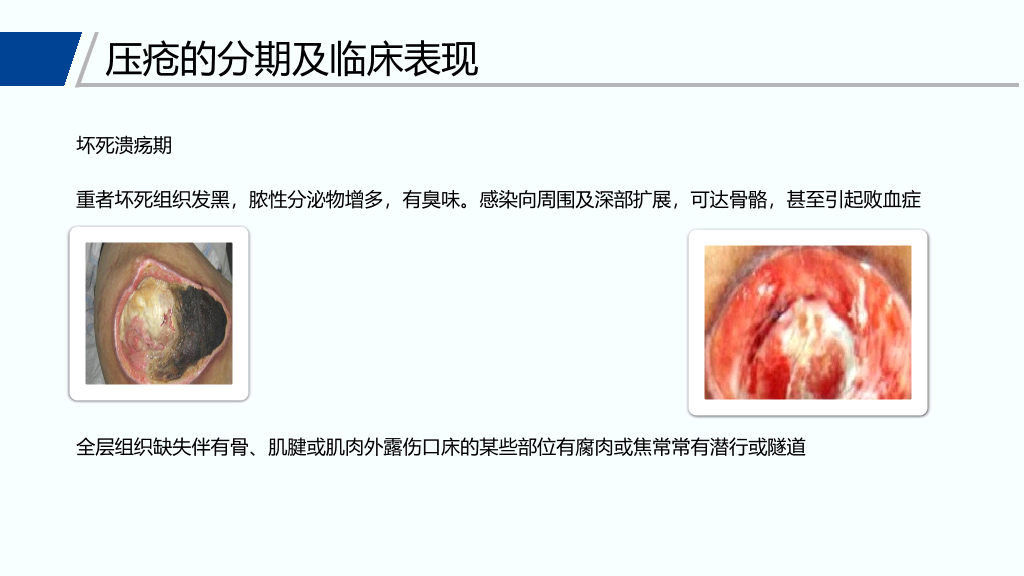 105#压疮预防和护理