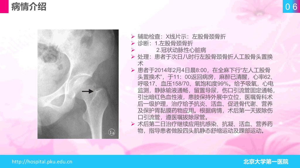 105#股骨颈骨折护理查房-1