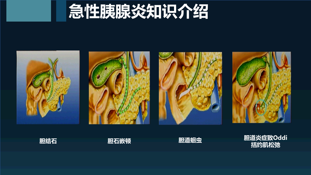 105#急性胰腺炎护理查房-2