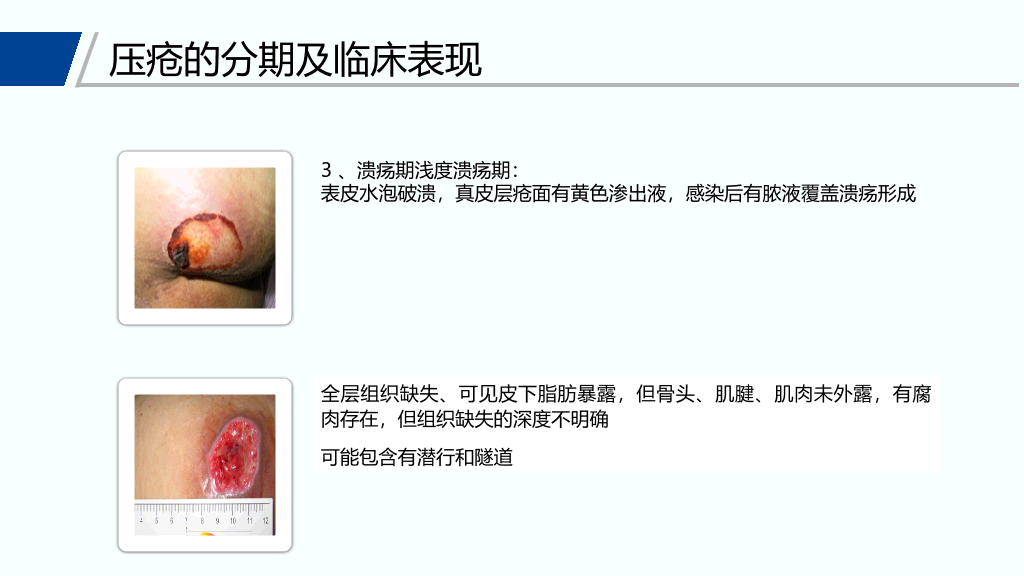 105#压疮预防和护理