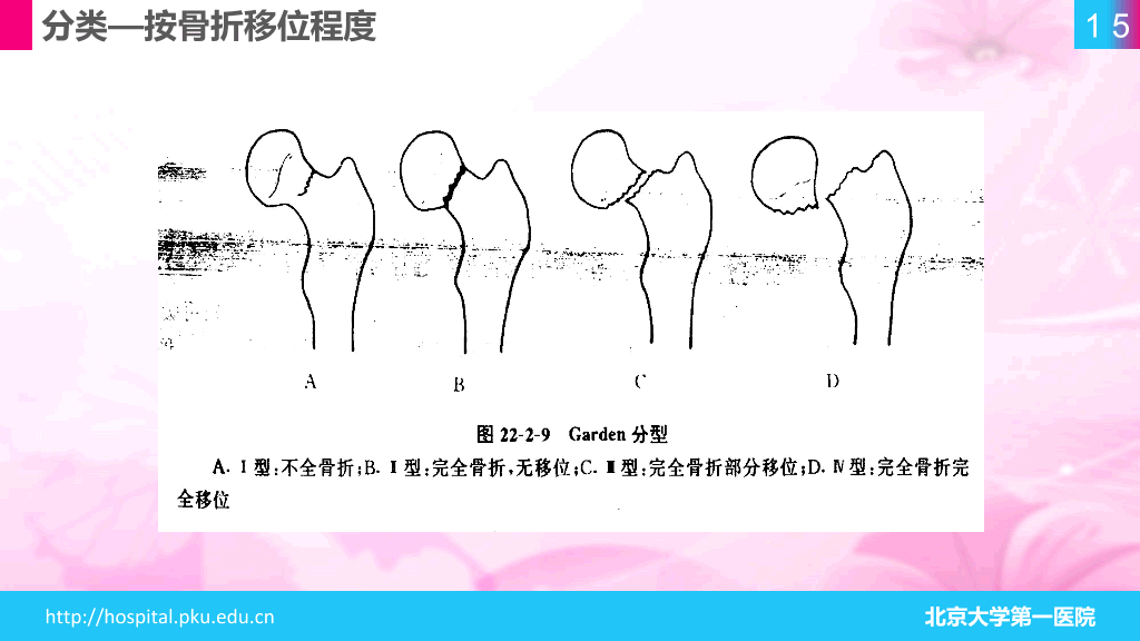 105#股骨颈骨折护理查房-1